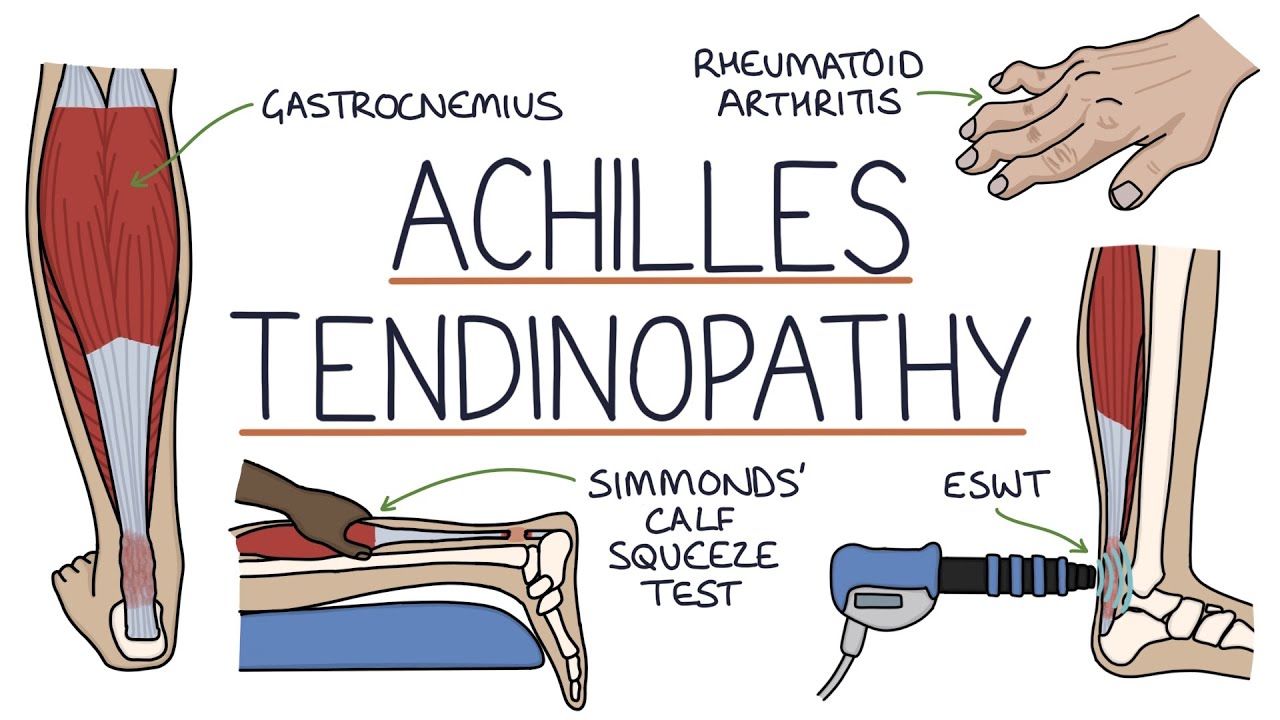 Understanding Achilles Tendinopathy (Achilles Tendinitis)