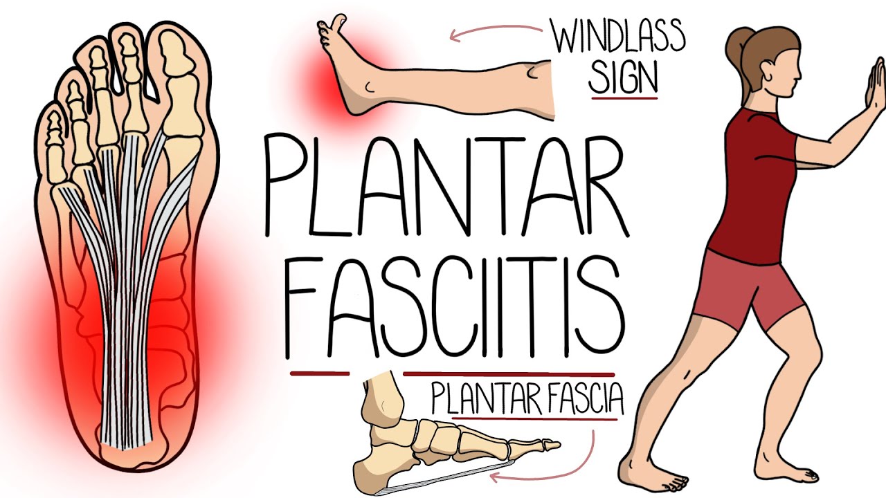 Plantar Fasciitis Explained Clearly (Including Treatment Options!)